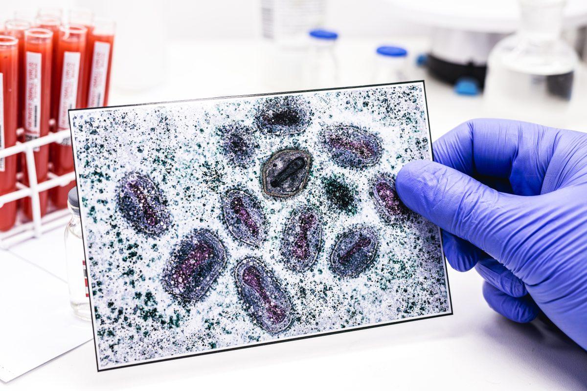 A hand of a pharmacist holds up a microscopic image of the monkeypox virus, which causes the disease and is similar to smallpox. Photo from FreePik
